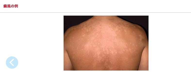 医療英語で皮膚科の病名・症状をまとめてみました！【皮膚トラブル編 